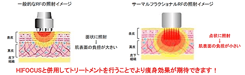 HIFOCUSと併用してトリートメントを行うことでより痩身効果が期待できます